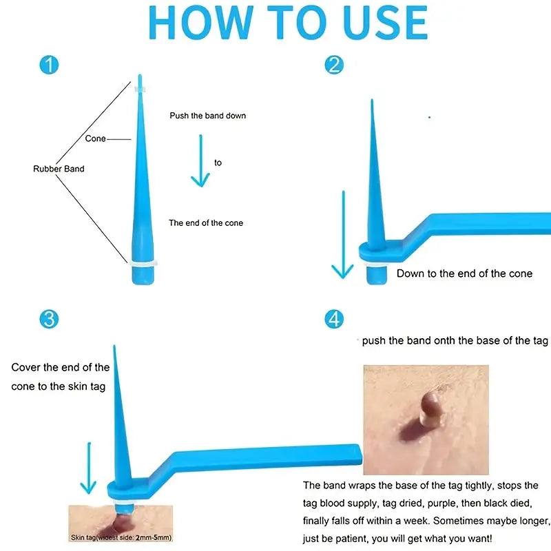 Skin Tag Kill Skin Mole Wart Remover Micro Skin Tag Removal Kit