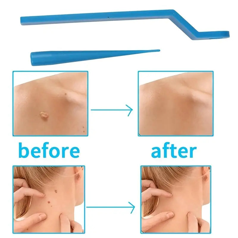 Skin Tag Kill Skin Mole Wart Remover Micro Skin Tag Removal Kit