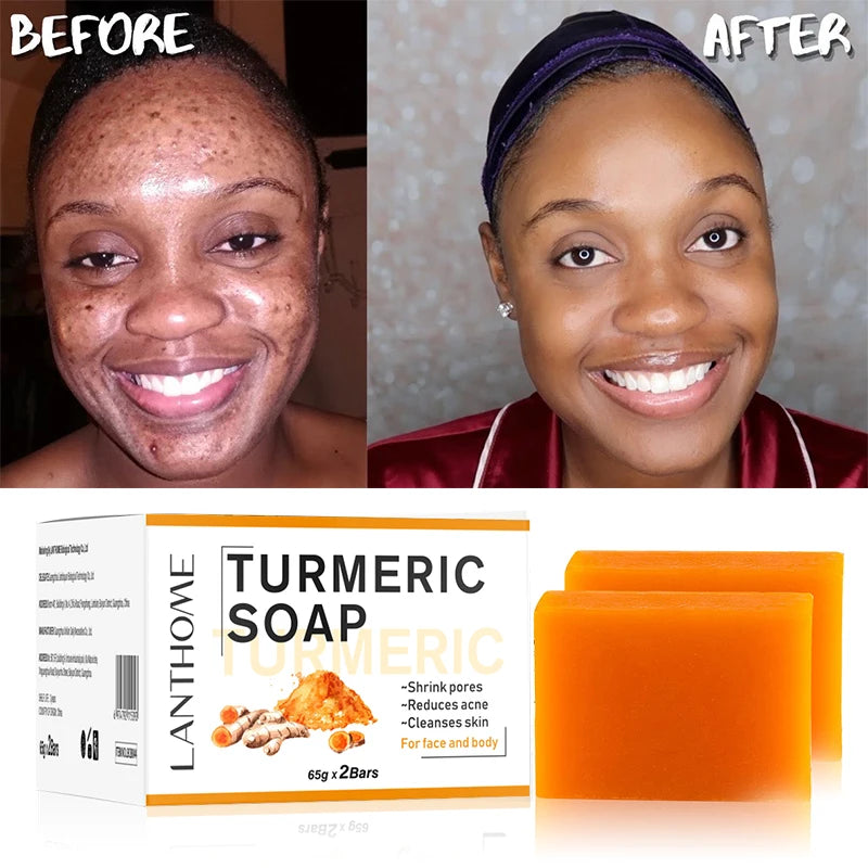 Natural Handmade Removing Acne Tumeric Soap &  Skin Brightening Serum