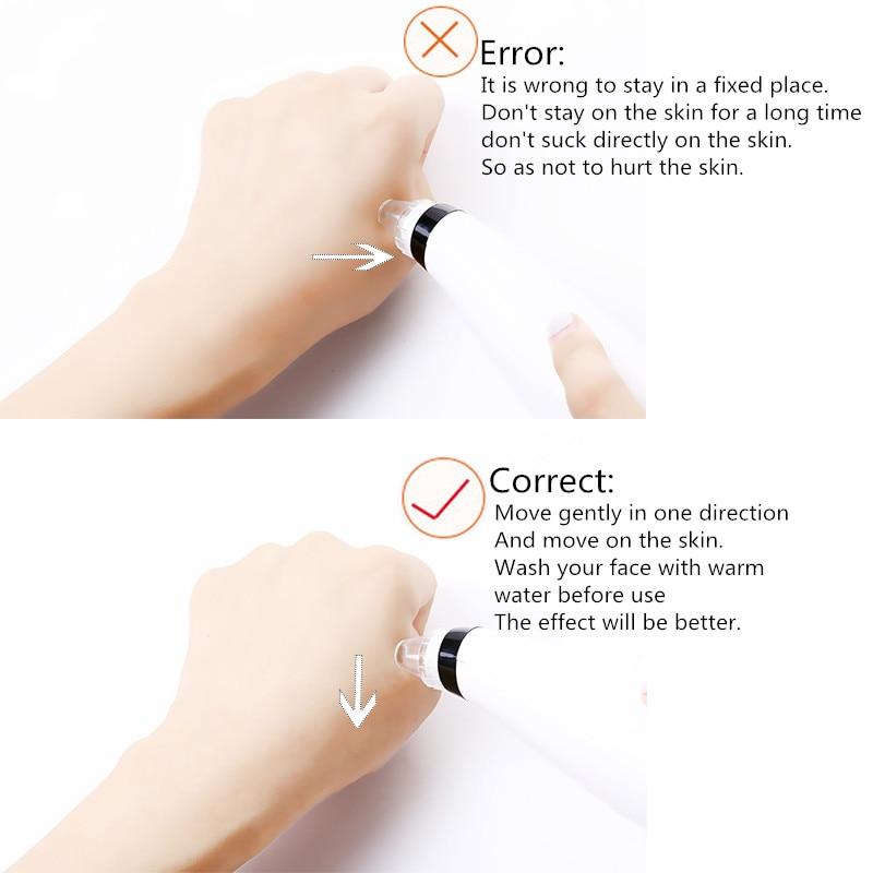 Facial Blackhead Remover