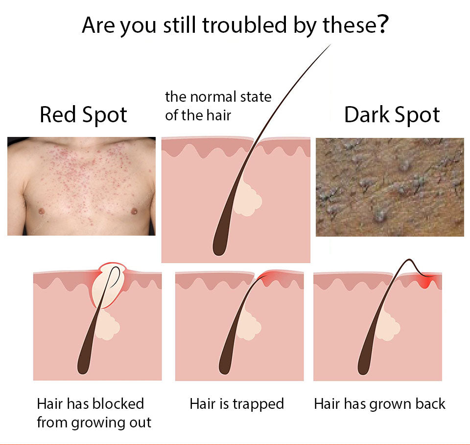 Razor bumps and Ingrown Hair treatment  After Shave vanish pfb for Ingrown Hairs and Razor Burns roll on for black Men and Women