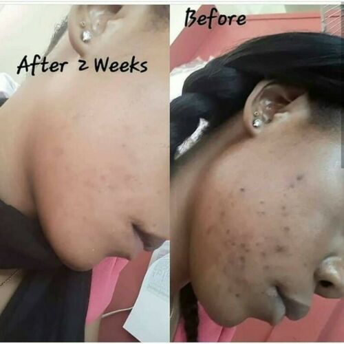 Tumeric Soap Skin Brightening Ezecma Blemishes Psoriasis Acne Dark Spots Remover Clear Scrub